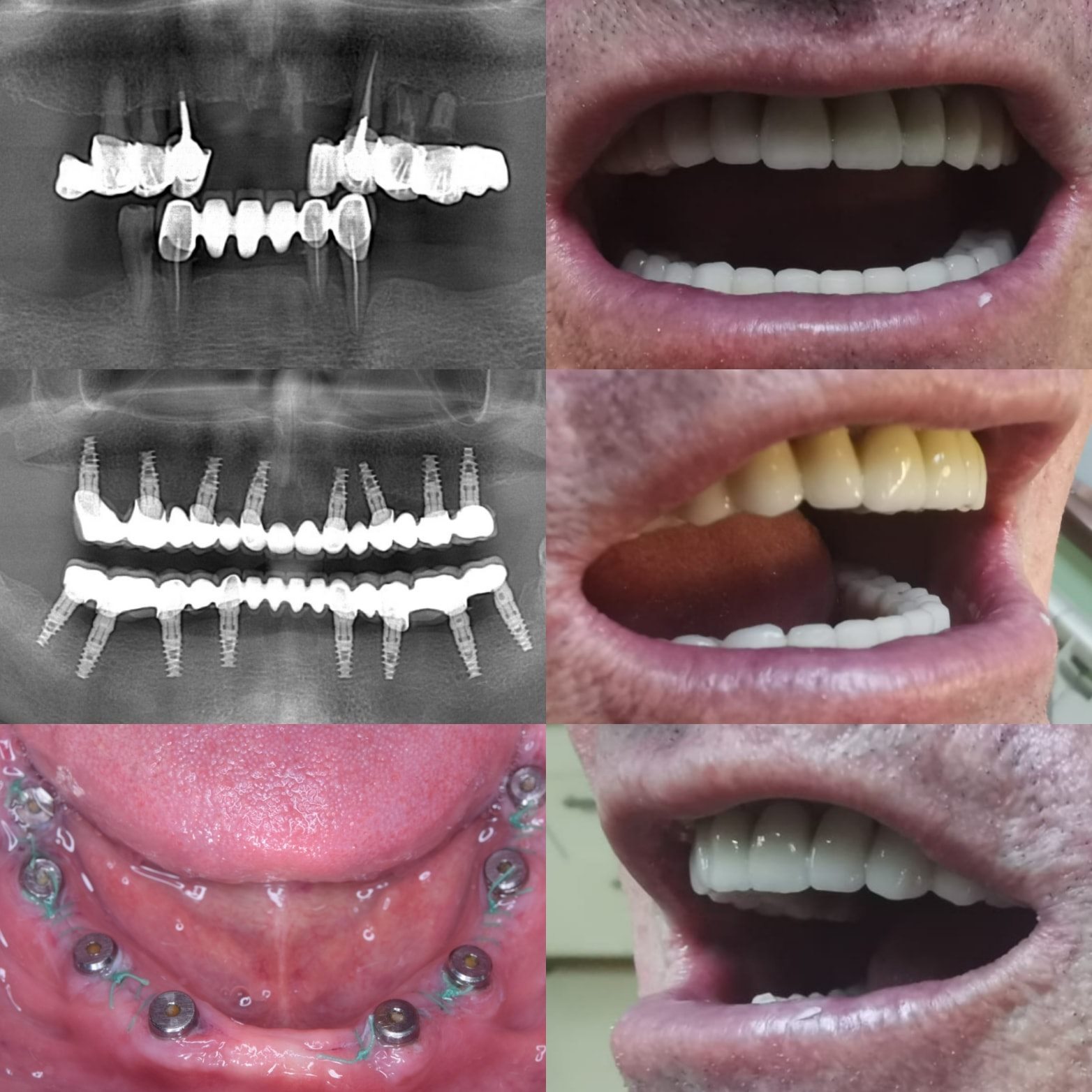 pret implant dentar pret implant dentar